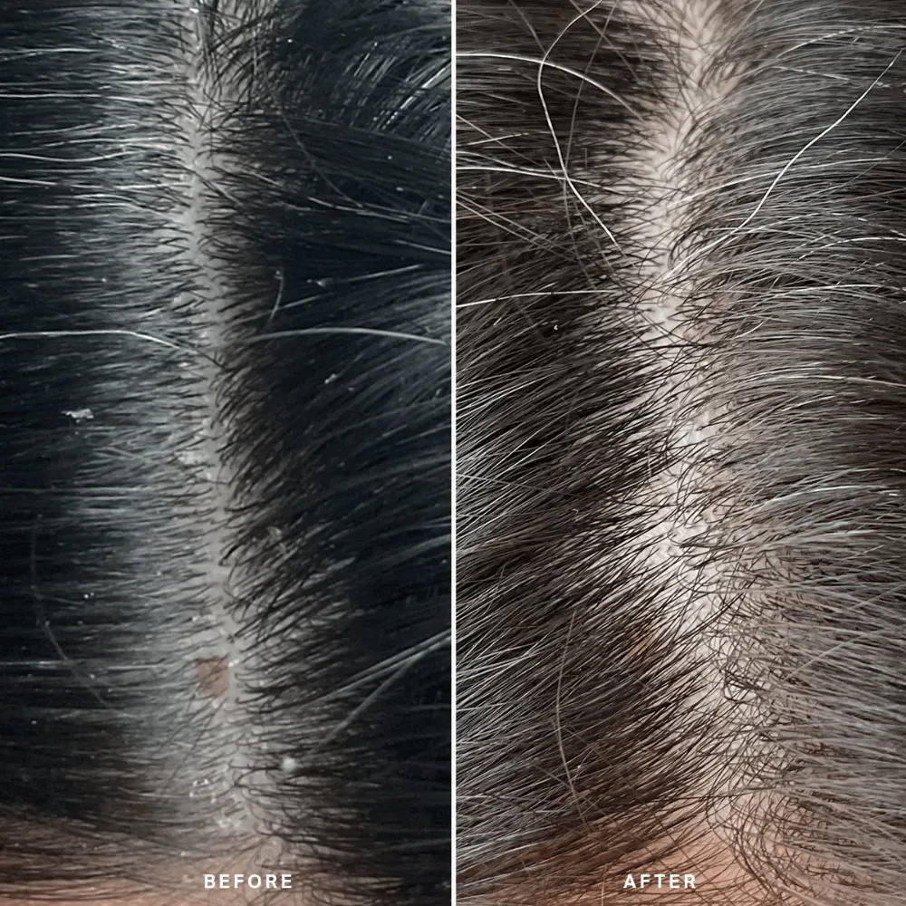 Alpha-H Healthy Scalp Exfoliating Treatment 100ml - Image 9