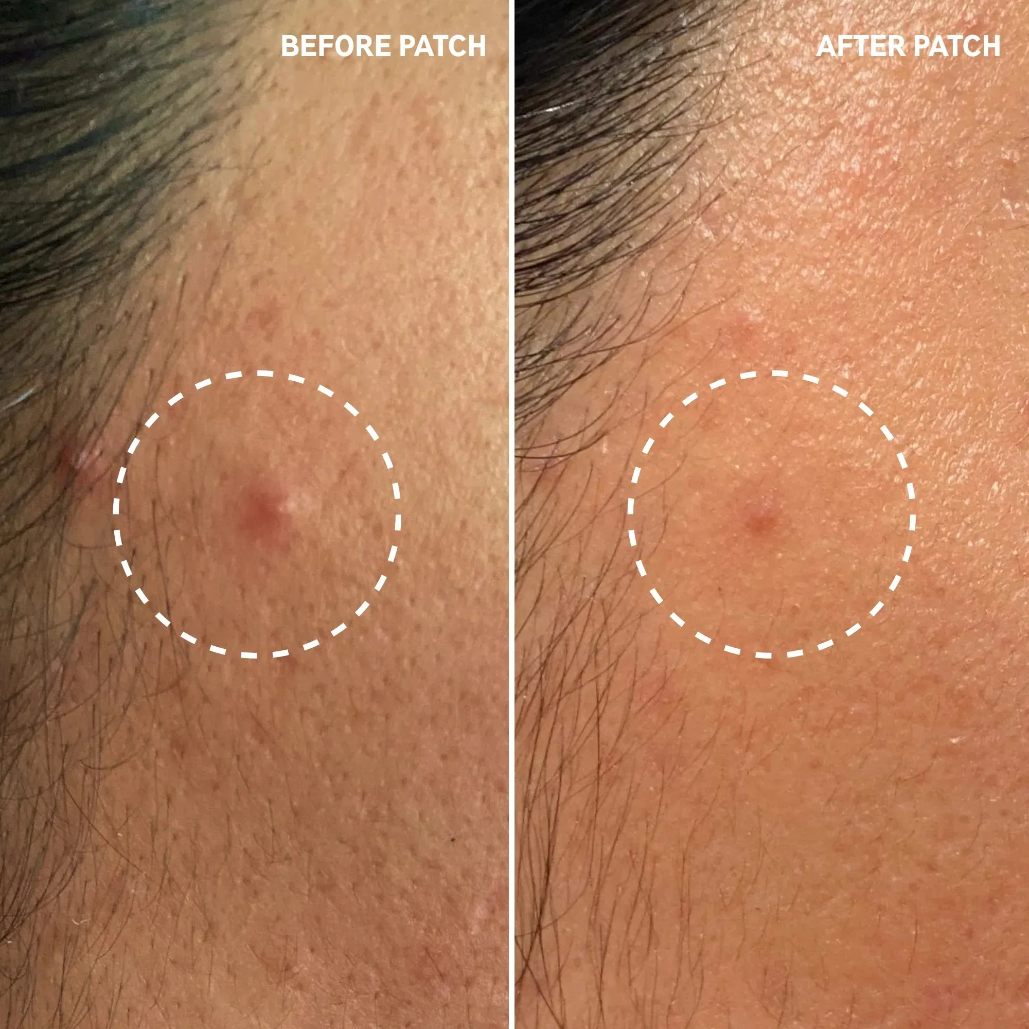The INKEY List Hydrocolloid Invisible Pimple Patches - Image 2