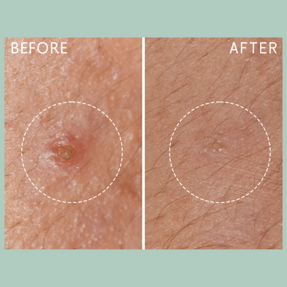 Lierac Anti-Blemish Protocol The Stop Spots 15ml - Image 4